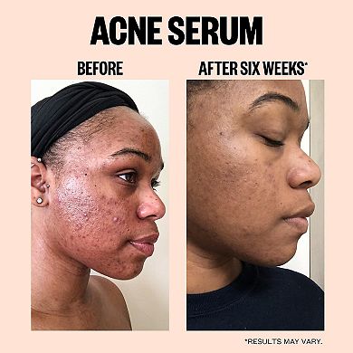 Salicylic Acid Acne Treatment Serum