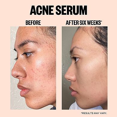 Salicylic Acid Acne Treatment Serum