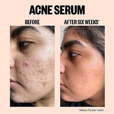 Salicylic Acid Acne Treatment Serum