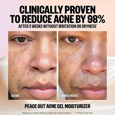 2% Salicylic Acid Acne Gel Moisturizer