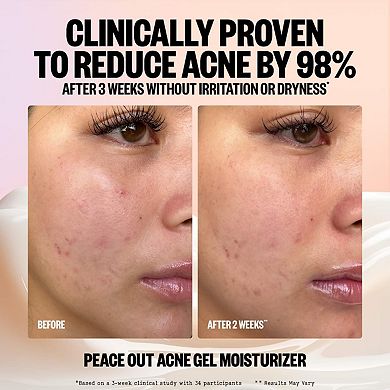 2% Salicylic Acid Acne Gel Moisturizer