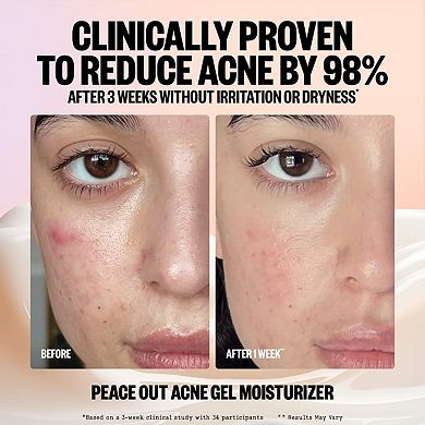 2% Salicylic Acid Acne Gel Moisturizer