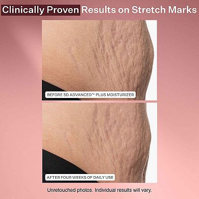 SD Advanced PLUS Intensive Moisturizer for Stretchmarks and Wrinkles