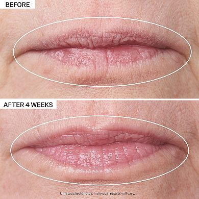 Double Fix for Lips Plumping & Vertical Line Treatment