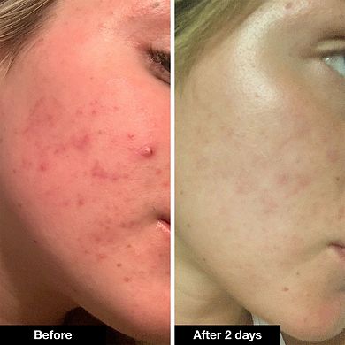 Pimple Paste Overnight Blemish Spot Treatment