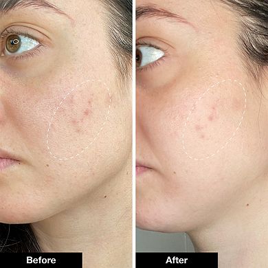 Pimple Paste Overnight Blemish Spot Treatment