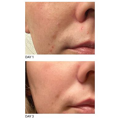 DRx Blemish Solutions Acne Eliminating Gel