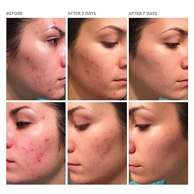 DRx Blemish Solutions Acne Eliminating Gel