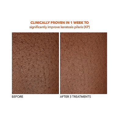Alpha Beta Exfoliating Body Treatment Peel