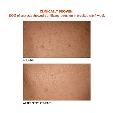 Alpha Beta Exfoliating Body Treatment Peel