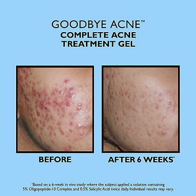 Goodbye Acne Complete Acne Treatment Gel