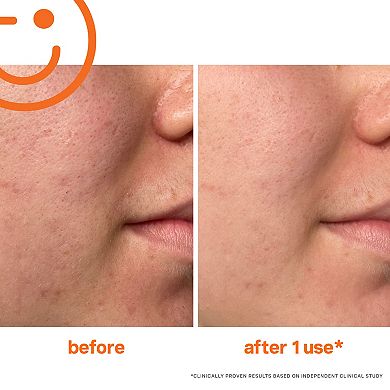 ExfoliKate Intensive Exfoliating Treatment