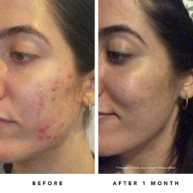 Blue Tansy BHA and Enzyme Pore Refining Mask
