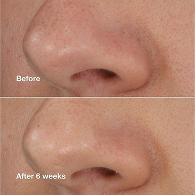 Blackhead Solutions Self-Heating Blackhead Extractor with Salicylic Acid