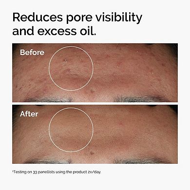 Niacinamide 10% + Zinc 1% Serum for Oily Skin