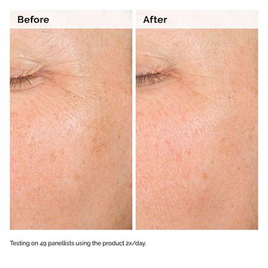Alpha Arbutin 2% + Hyaluronic Acid for Hyperpigmentation