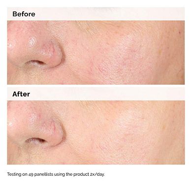 Alpha Arbutin 2% + Hyaluronic Acid for Hyperpigmentation