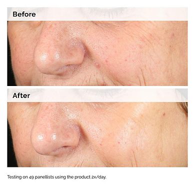 Alpha Arbutin 2% + Hyaluronic Acid for Hyperpigmentation