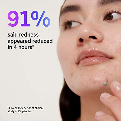 Succinic Acid Acne Treatment