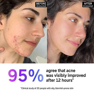 Succinic Acid Acne Treatment