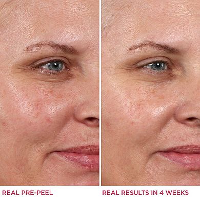 Hello Results Baby-Smooth Glycolic Peel + Caring Oil