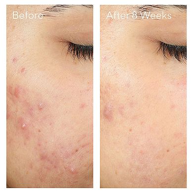 InvisiScar Post-Acne Resurfacing Treatment