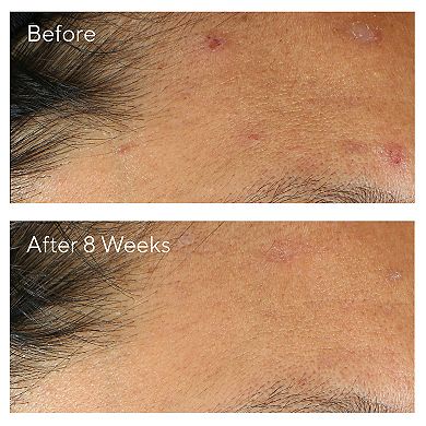 InvisiScar Post-Acne Resurfacing Treatment