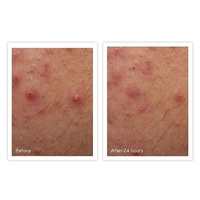 Rapid Relief Acne Spot Treatment