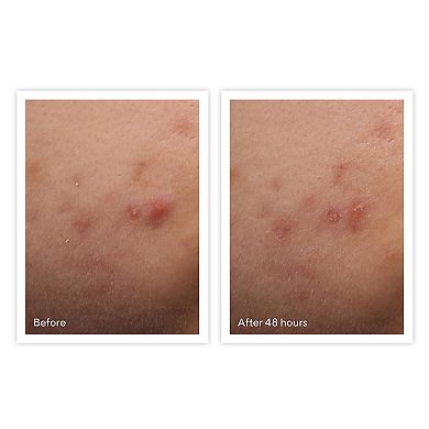 Rapid Relief Acne Spot Treatment