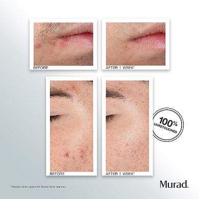 Outsmart Acne Clarifying Treatment