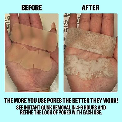 Oil-Absorbing Pore Treatment Strips