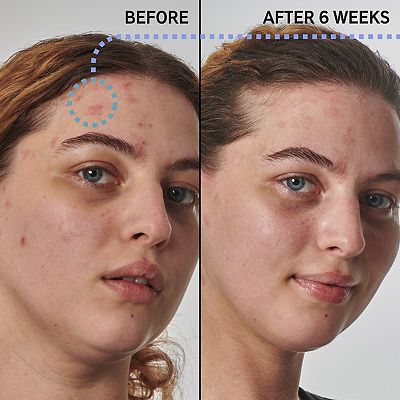 The INKEY List SuperSolutions 10% Urea Moisturizer Textured Skin Solution
