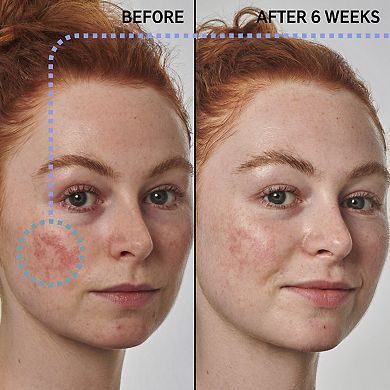 SuperSolutions 10% Azelaic Serum Redness Relief Solution