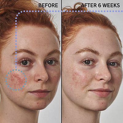 The INKEY List SuperSolutions 10% Azelaic Serum Redness Relief Solution