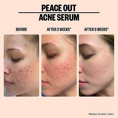 Peace Out Salicylic Acid Acne Treatment Serum