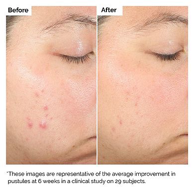 Salicylic Acid 2% Solution, Exfoliating Serum for Acne