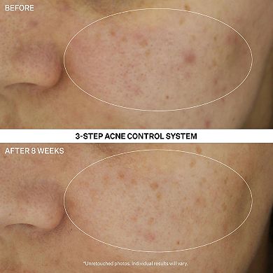 Multi Action Clear Acne Control 30-Day Trial Kit