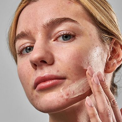 SuperSolutions Acne Clearing Moisturizer 2% NOVORETINTM