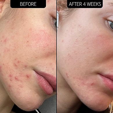 SuperSolutions Acne Clearing Moisturizer 2% NOVORETINTM