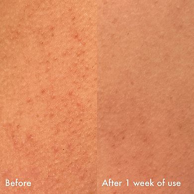 Confidently Clear Body Moisturizer with Lactic & Hyaluronic Acids