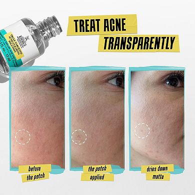 Truly Targeted Acne-Clearing Liquid Pimple Patch with Salicylic Acid