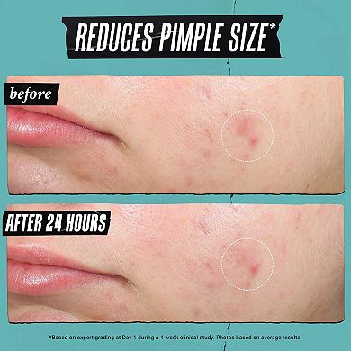 Truly Targeted Acne-Clearing Pimple Patch with Salicylic Acid