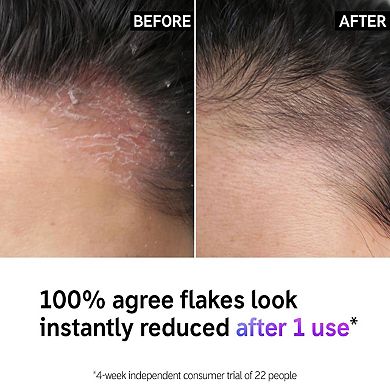 Salicylic Acid Oily Scalp Treatment