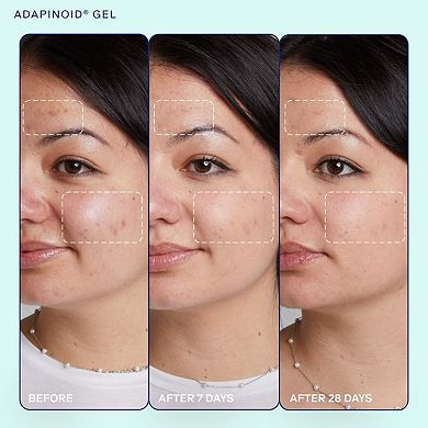 acne+ adapinoid Gel with Niacinamide + Squalane