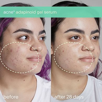 acne+ adapinoid Gel with Niacinamide + Squalane