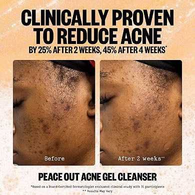 2% Salicylic Acid Acne Gel Cleanser