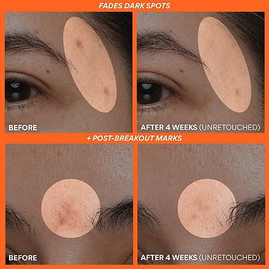 Rapid Vitamin C Brightening Serum for Dark Spots + Post-Breakout Marks