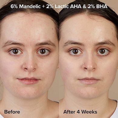 The Exfoliation Experience Kit with 2% BHA + 6% Mandelic Acid AHA