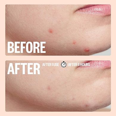 Acne Dot Mega Pack