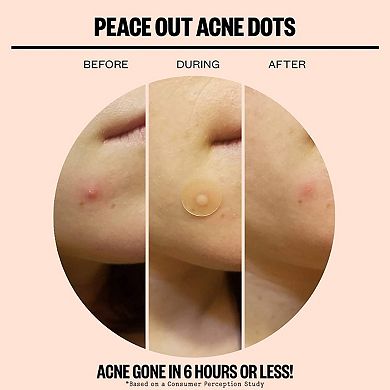 Salicylic Acid Acne Healing Dots